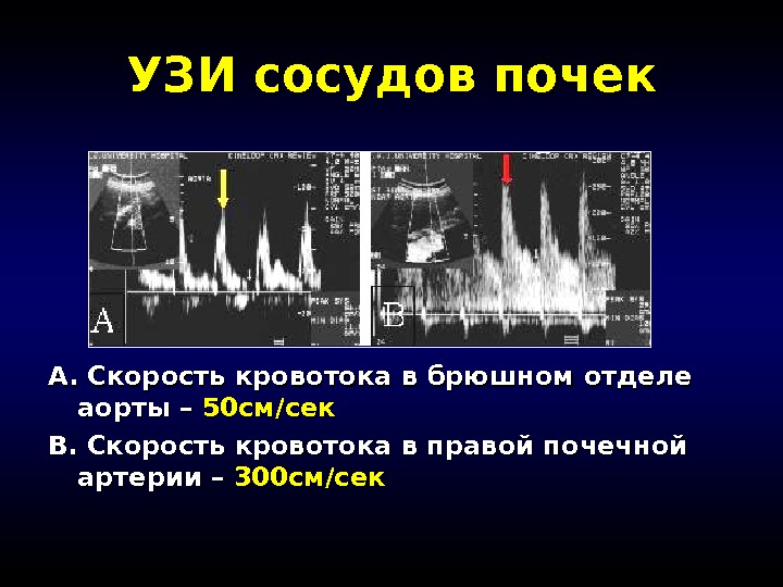 Определение скорости кровотока в сосудах. Скорость кровотока в почечных артериях. Кровоток в почечных артериях норма. Показатели скорости кровотока в почечных артериях в норме. Нормы скоростей в почечных артериях.