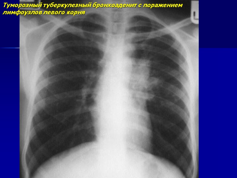 Рентгенодиагностика очагового и инфильтративного туберкулеза легких ...