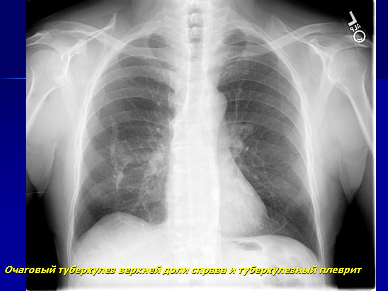 Рентгенодиагностика очагового и инфильтративного туберкулеза легких ...