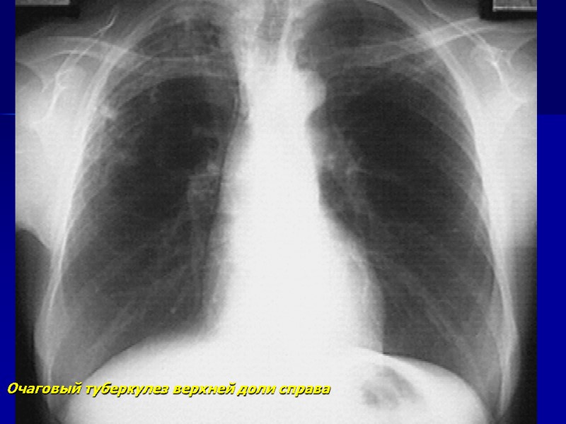 Рентгенодиагностика очагового и инфильтративного туберкулеза легких ...