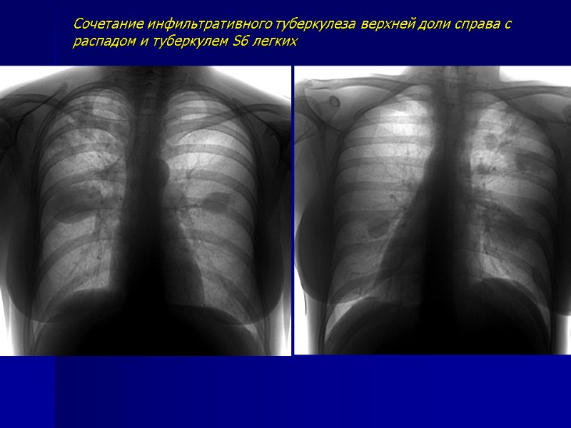 Рентгенодиагностика очагового и инфильтративного туберкулеза легких ...