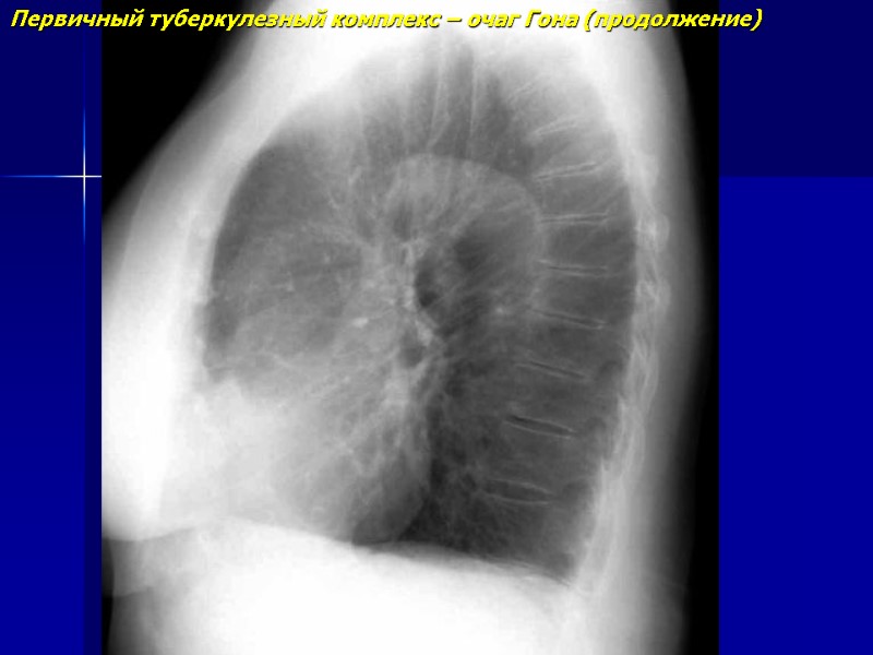 Рентгенодиагностика очагового и инфильтративного туберкулеза легких ...