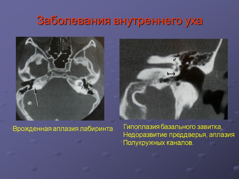 Заболевания внутреннего уха презентация