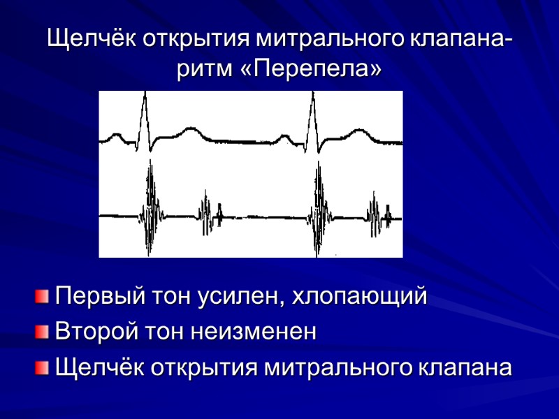 Тон открытия митрального клапана