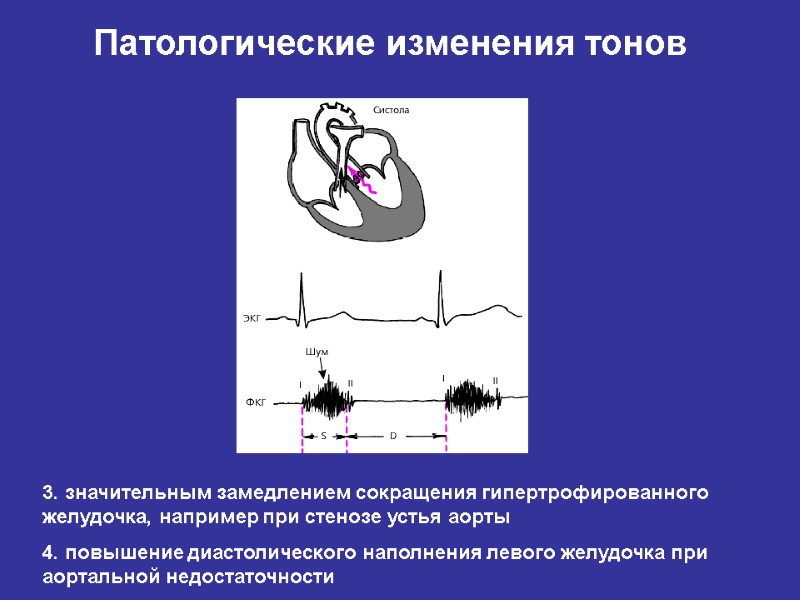 Аускультативная картина i тона сердца при стенозе устья аорты