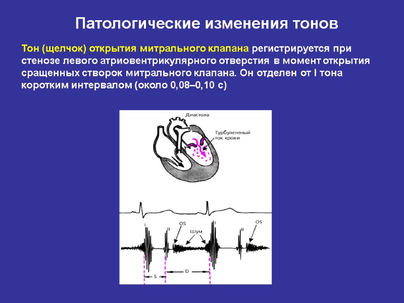 Аускультативная картина при митральном стенозе сердца включает на верхушке