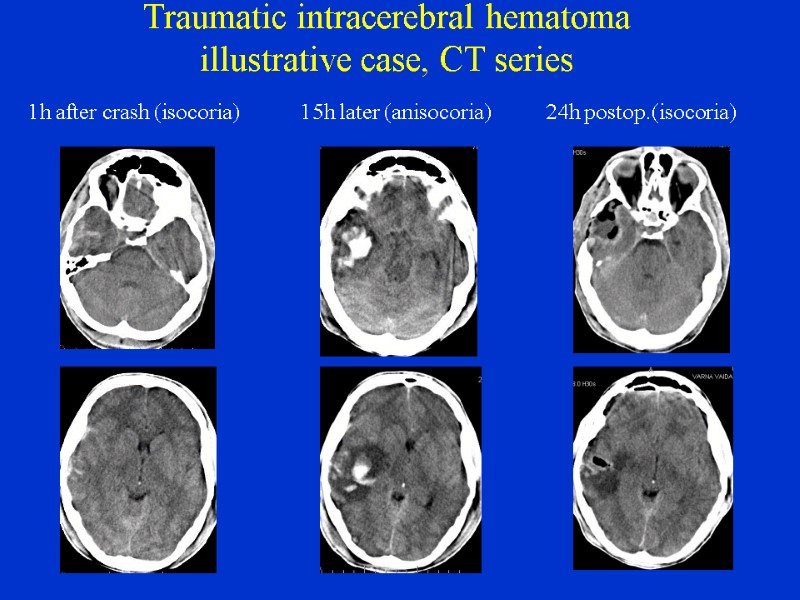 case study craniocerebral trauma