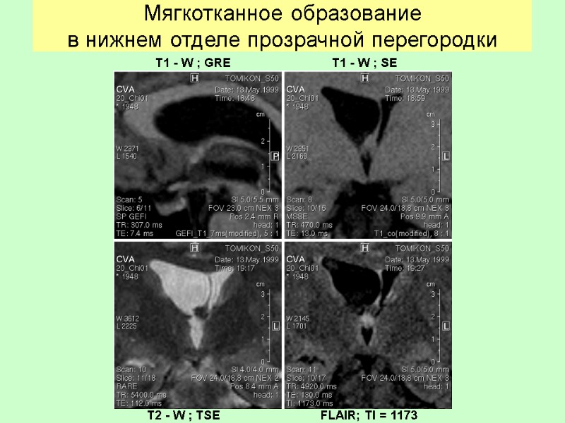 Мягкотканное образование в легком на кт. Мягкотканное образование. Негомогенное мягкотканное образование. Образования прозрачной перегородки.