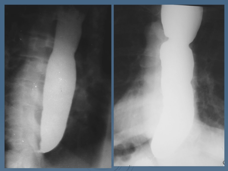 Еsophageal disease (stricture, diverticula, achalasia) Surgery department №2,