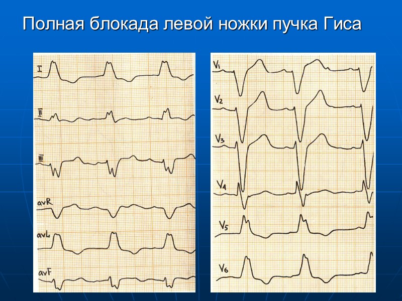 Критерии сгарбоссы для диагностики инфаркта миокарда на фоне полной блокады левой ножки пучка гиса