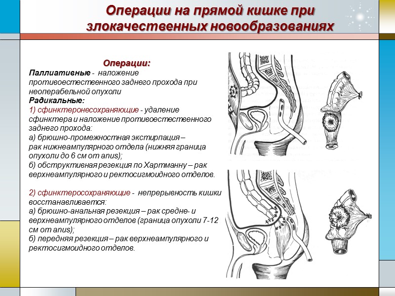 Презентация операции на прямой кишке