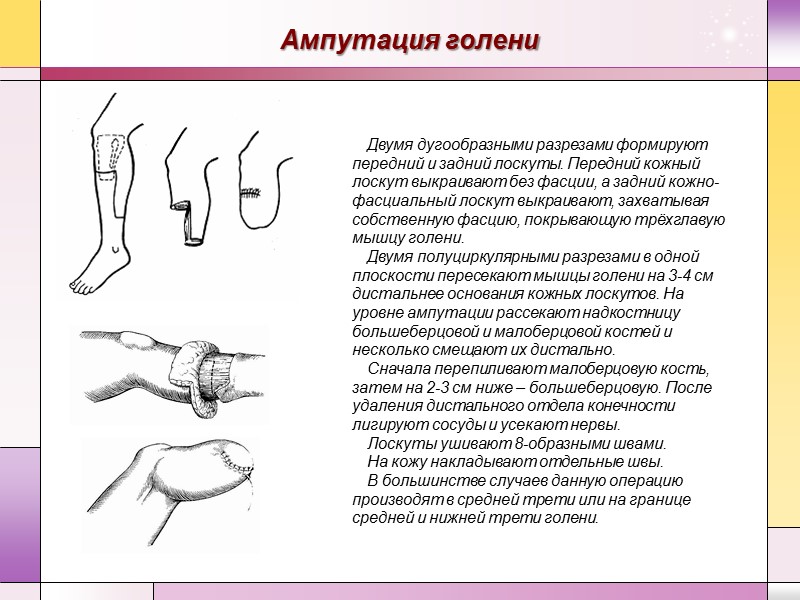 Травматическая ампутация пальцев кисти мкб