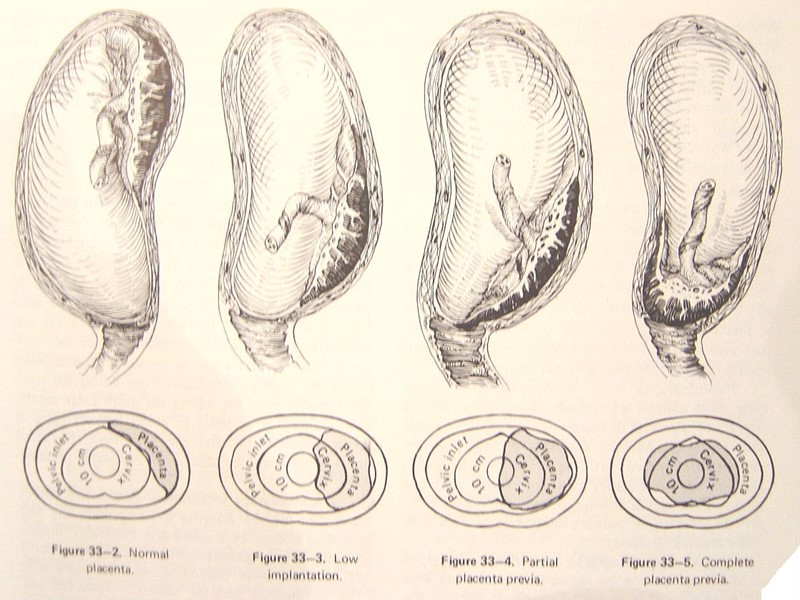 Semey State Medical University Topic Placenta Previa Prepared