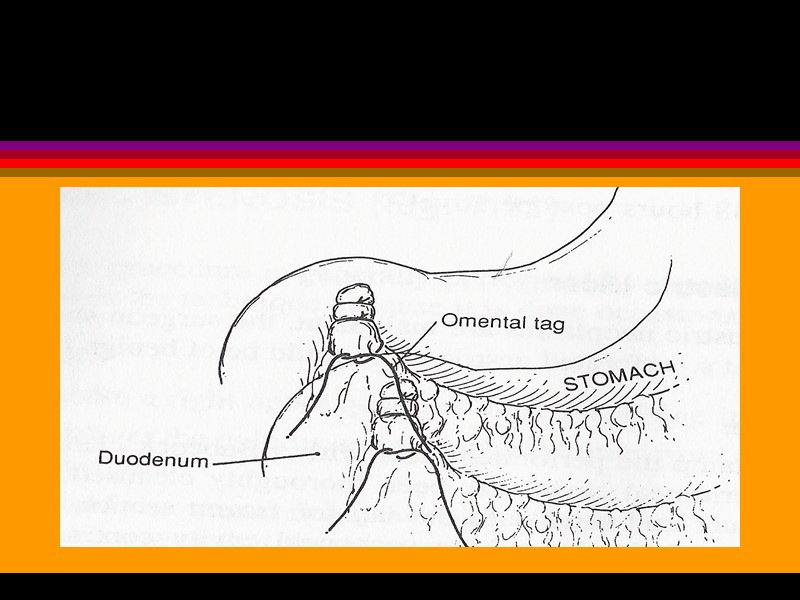 Graham's Patch Асқазан мен 12-елі ішектің жара ауруы. PEPTIC ULCERS