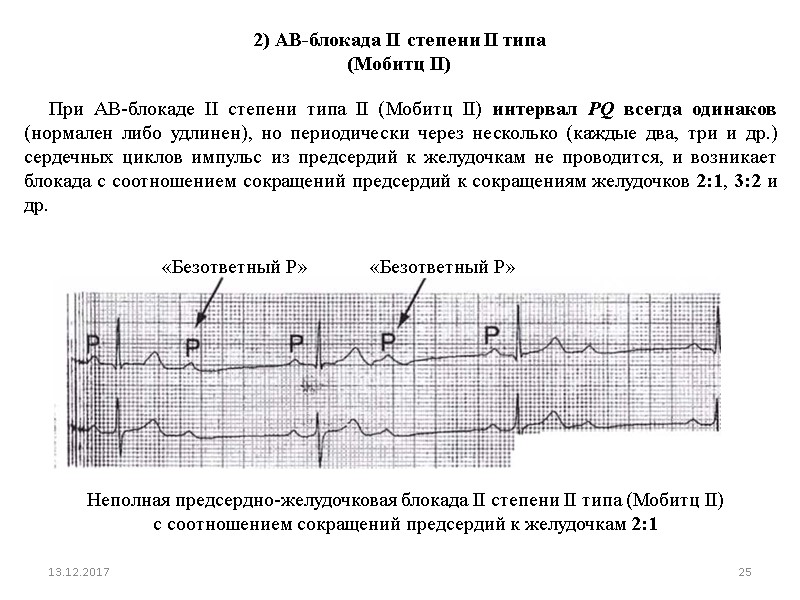 Давление блокада. ЭКГ при АВ блокаде 2 степени Мобитц. АВ блокада 2 степени типа Мобитц 2. АВ блокада 2 степени 1 типа Мобиц. Атриовентрикулярная блокада 2 степени на ЭКГ.