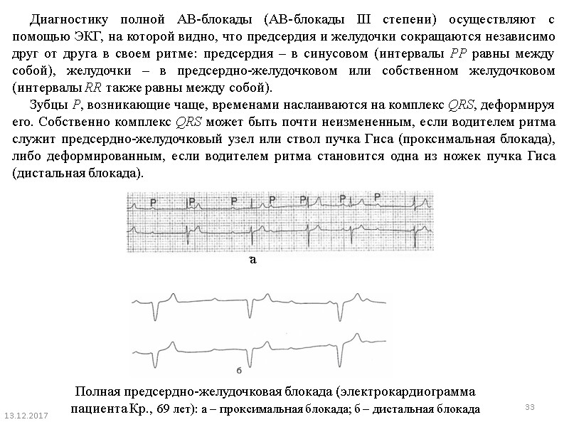 Полная блокада на экг. АВ блокада 3 степени заключение ЭКГ. Проксимальная АВ блокада 3 степени. Заключение ЭКГ АВ блокада 2 степени. Заключение ЭКГ при полной АВ блокаде.