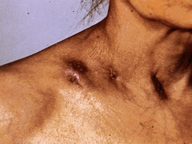 Осложнения туберкулезной волчанки  часто рецидивирующее рожистое воспаление лица лимфостаз рак кожи (4%)