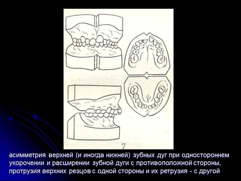 Лицевые признаки  дистального прикуса