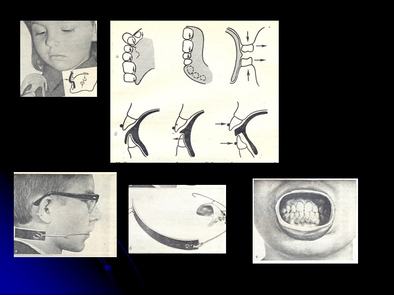 Ю.М. Малыгин (1970) выделил 9 разновидностей дистального прикуса: без деформации зубных дуг с боковым