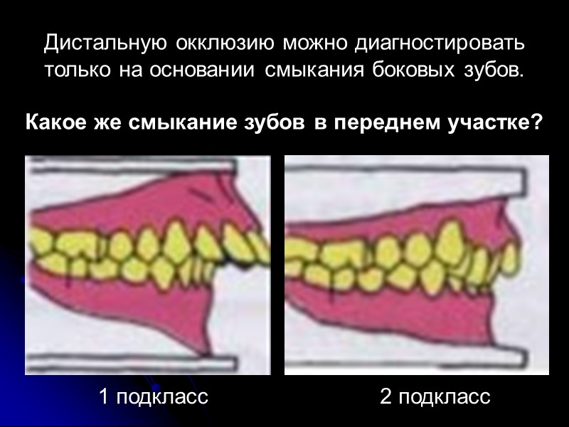 с укорочением и сужением зубных дуг и ретрузией всех резцов