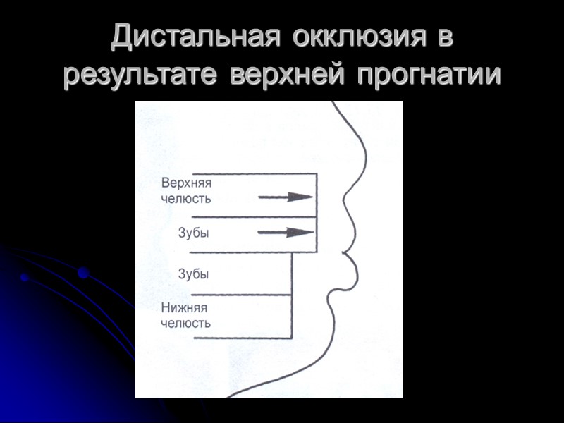 Омега-петля перед коронкой моляра