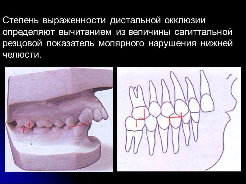 Дистальная окклюзия в результате верхней прогнатии