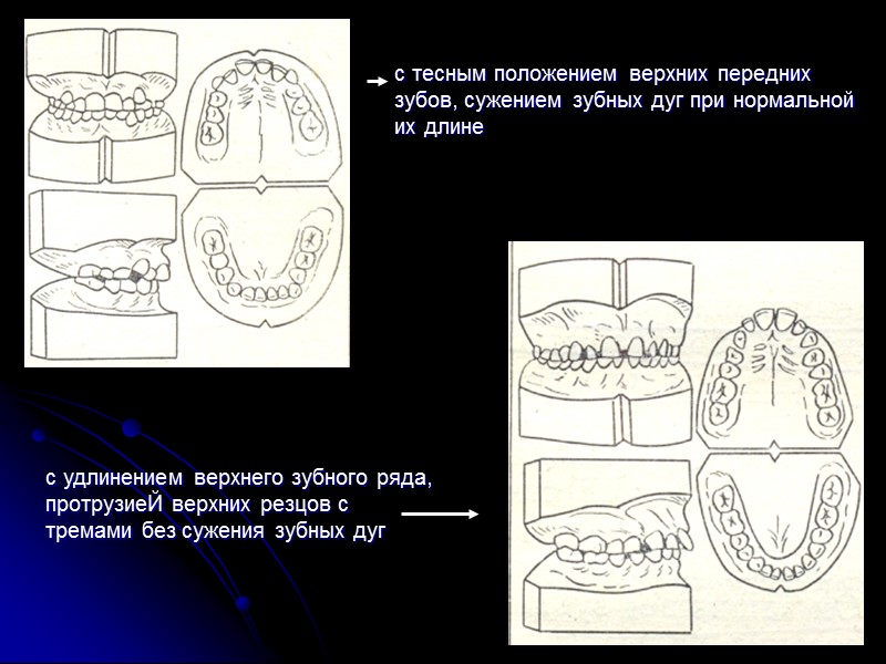 Лицевые признаки  дистального прикуса