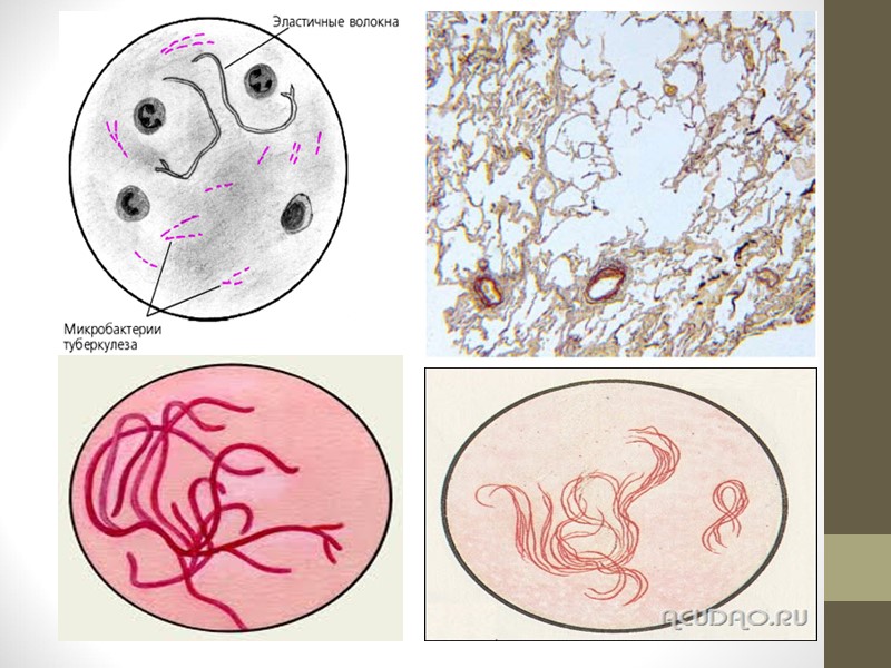 Б) Пневмобактерия Фридлендера (Bacterium Friedlanderi, Klebsiella pneumoniae). Пневмобактерии — короткие овоидные палочки, соединенные попарно
