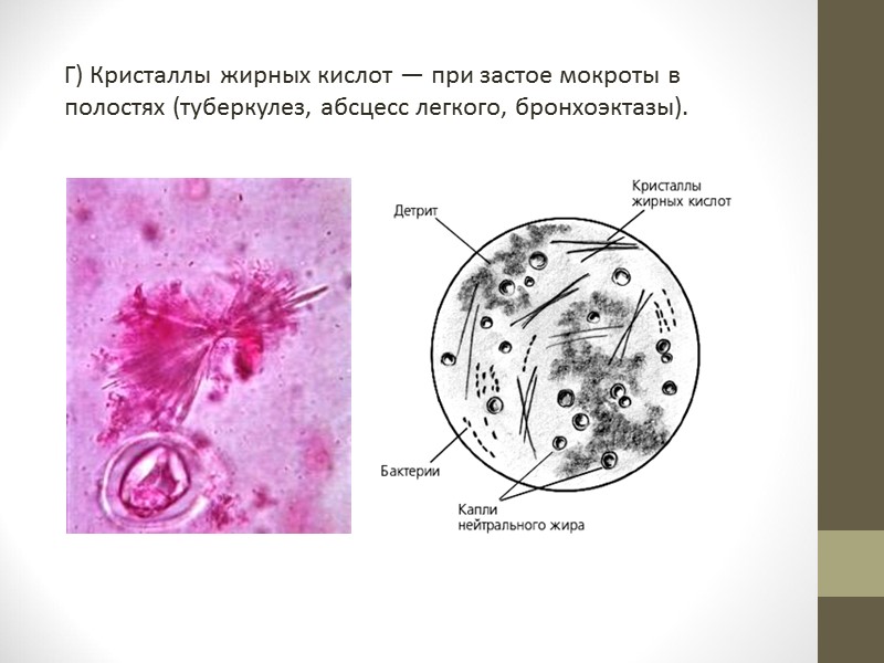 IV. Мокрота при различных заболеваниях Острый бронхит.   В  начале заболевания выделяется