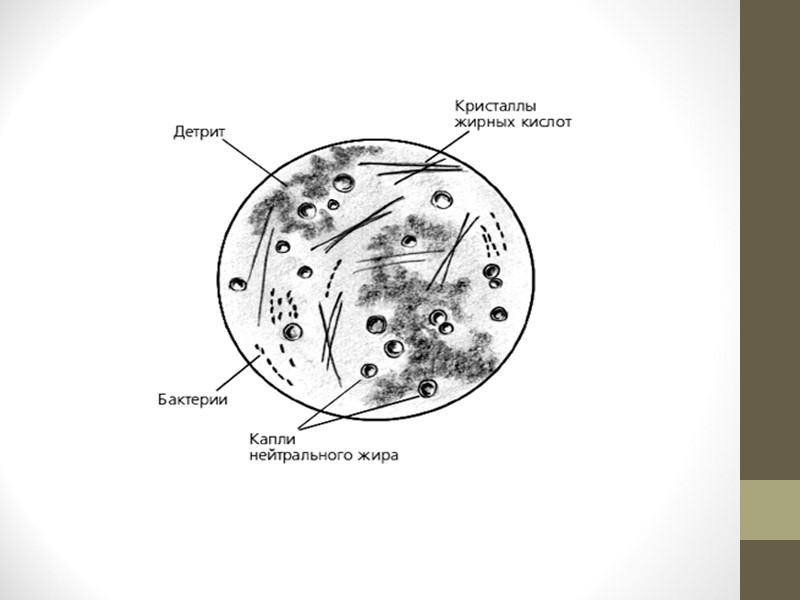 5)  Бронхопневмония.  Мокрота содержит эритроциты, клетки цилиндрического эпителия, а в некоторых случаях