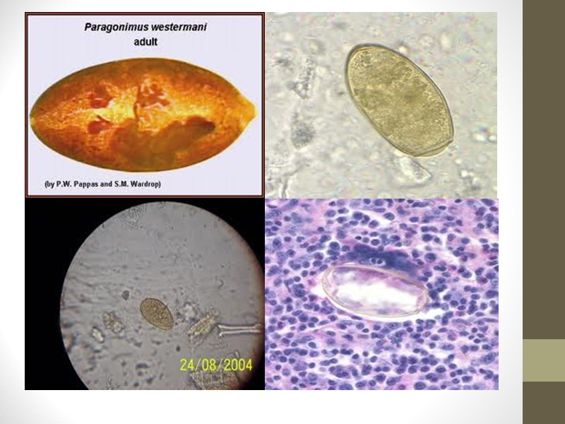 Патологические грибы Actinomyces israelli Это не настоящий грибок, а грамположительный микроорганизм, который медленно растет