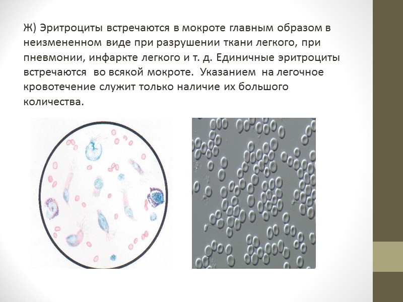 Появление эритроцитов в моче. Клетки мокроты нативный препарат. Эозинофилы в мокроте микроскопия. Эритроциты в мокроте микроскопия.