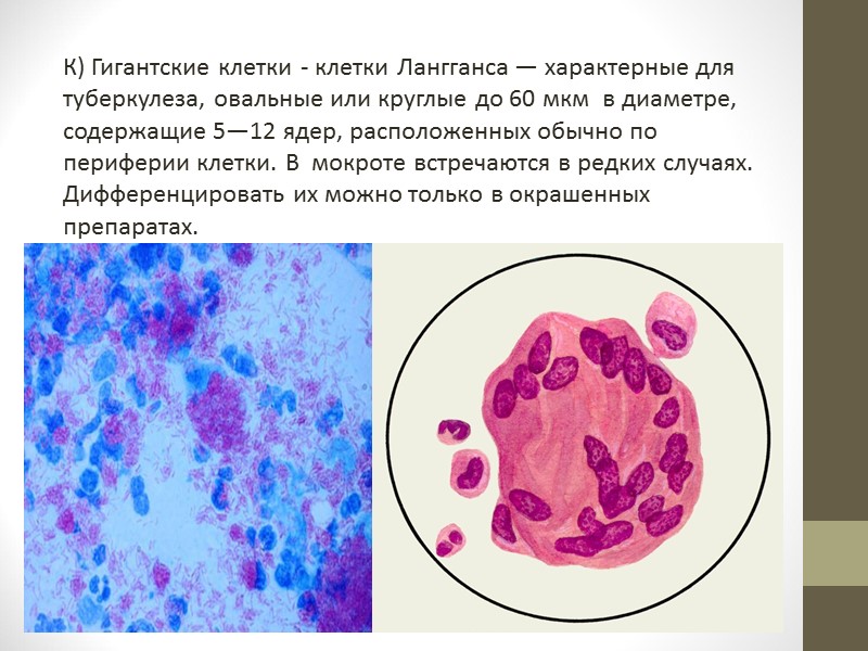 Атипичные клетки матки. Атипические клетки в мокроте. Исследование мокроты на атипичные клетки. Атипичные клетки в цитологии.