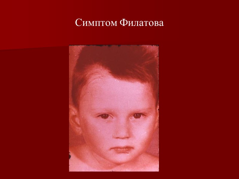 Инфильтрат (не исчезает при надавливании)  Папула  -     