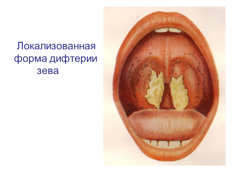 Действие дифтеритического токсина