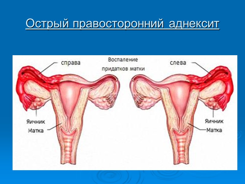 Нарушенная трубная беременность (по типу разрыва маточной трубы) Боль: внизу живота нередко схваткообразного характера