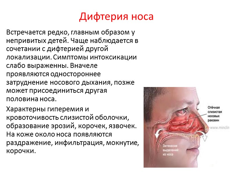 Клинические проявления А. Дифтерия зева   Б. Дифтерия кожи