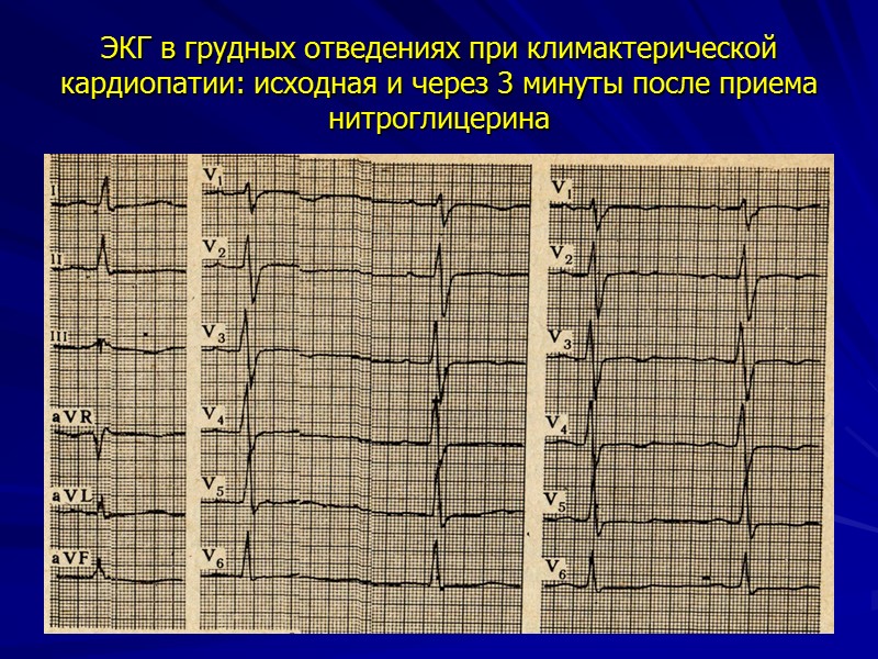 Клиника НЦД Признаки общего невроза Признаки вегетативной дисфункции  Сердечно-сосудистые нарушения   