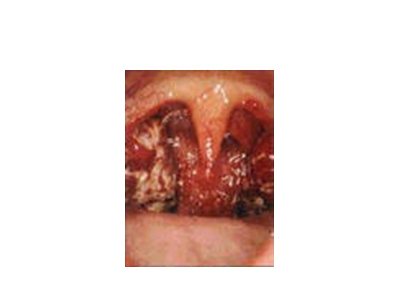 Токсическая дифтерия зева подразделяется на субтоксическую, гипертоксическую и геморрагическую формы.