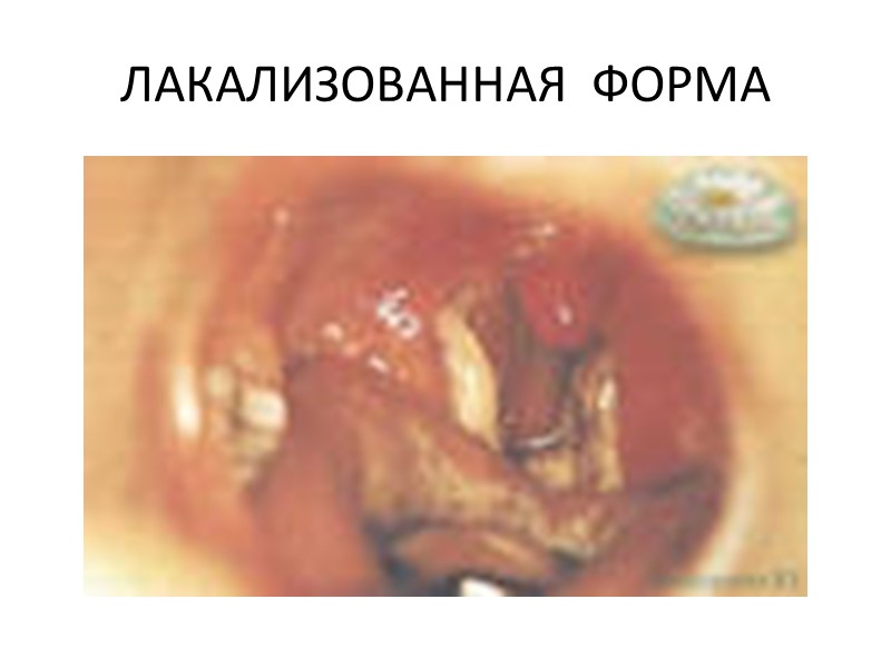 Геморрагическая форма Геморрагическая форма дифтерии зева характеризуется присоединением к клинической картине токсической дифтерии (чаще