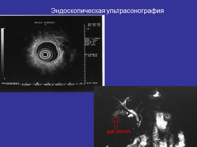 42 Ультразвуковое исследование (простой, неинвазивный метод, его можно повторять многократно) позволяет определить диаметр желчных