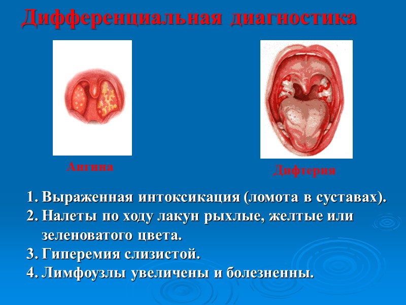 Смотреть фильм! 3 степень тяжести Отек клетчатки до сосков. Подчелюстные лимфоузлы размером с куриное