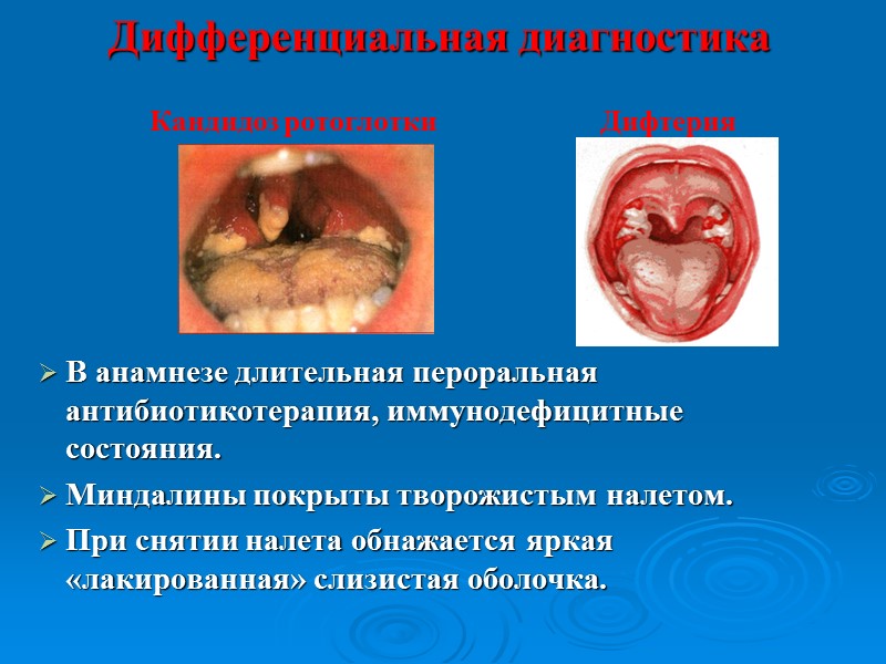 Дифтерия носа Заложенность носа. Слизисто-гнойные выделения. Лимфаденит. В носу кровянистые корочки и фибринозные пленки.