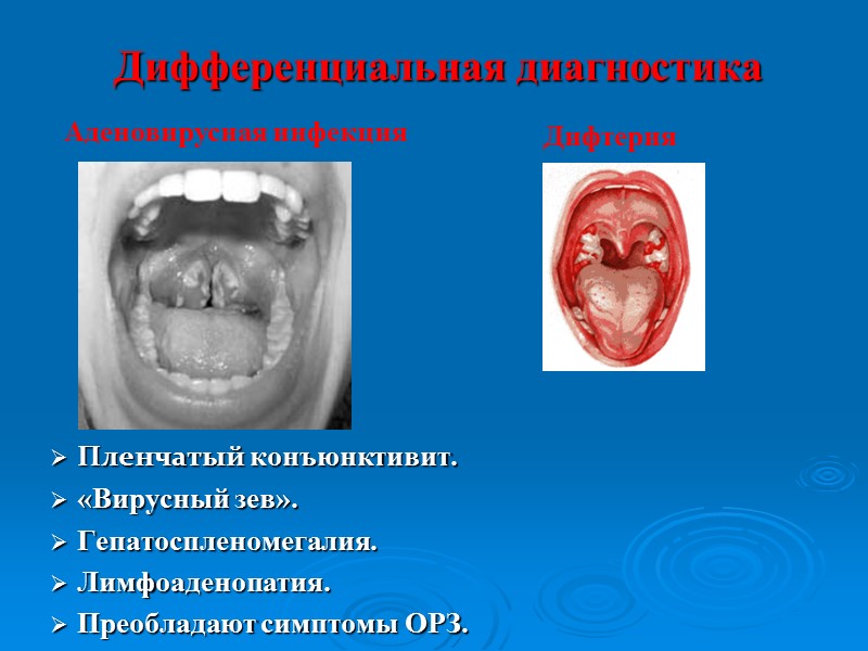 Дифтерия глаза Пленчатая форма. Токсическая форма.