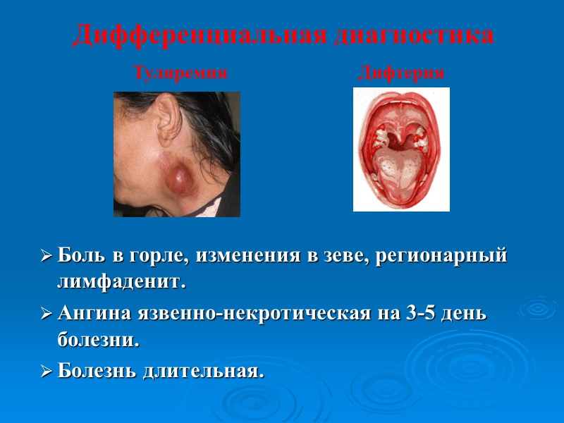 Дифтерия другой локализации Дифтерия рта. Дифтерия пищевода. Дифтерия половых органов. Дифтерия кожи.