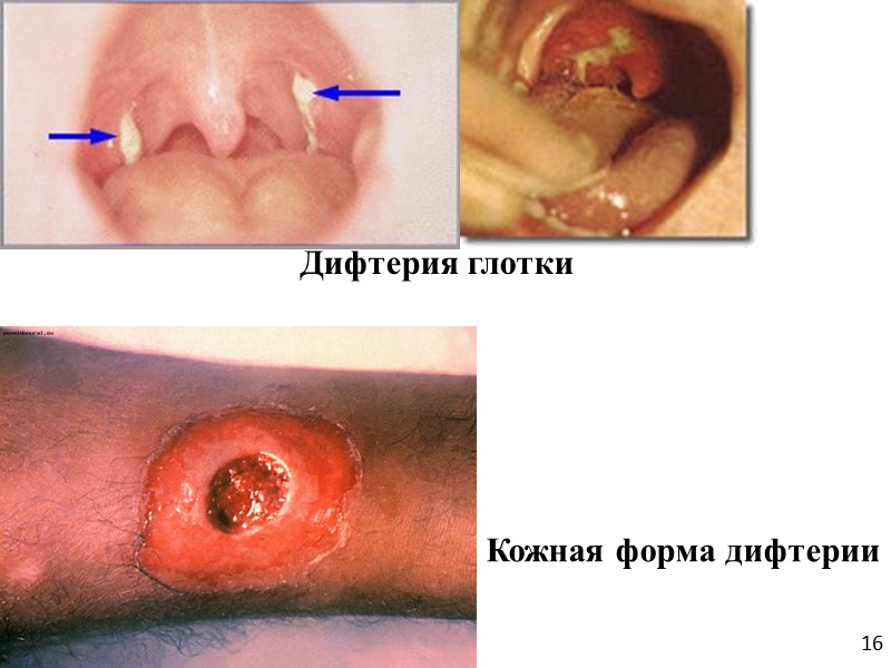 Электронная микрофотография бактериофага коринебактерии, несущего tox-ген