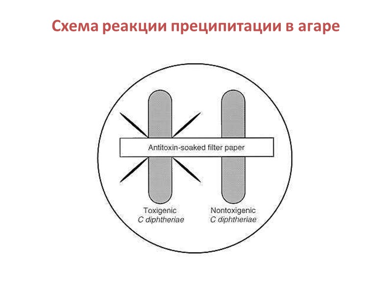 Дифтерия глотки Распространенная дифтерия ротоглотки: серовато-белые отторгающиеся налеты на гиперемированных с цианотичным оттенком небных