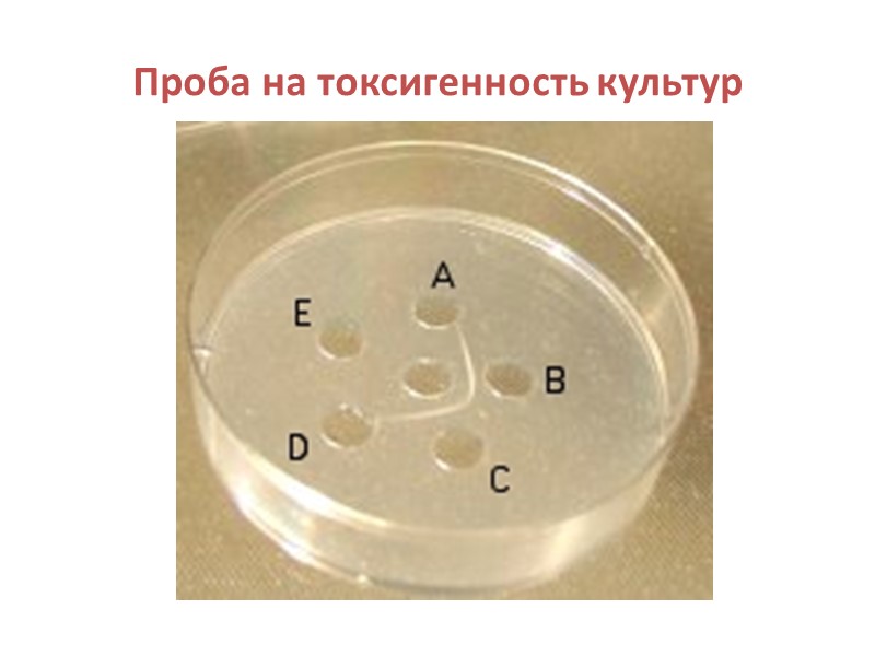 Дифтерия.  Выраженный отек шеи. Ребенок не может закрыть рот. Язык приподнят. Ринит. Субфебрильная