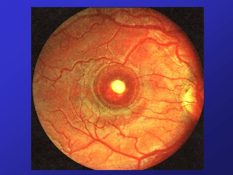 Воспаление сетчатки. Тапеторетинальная абиотрофия сетчатки. Пигментный ретинит сетчатки. Пигментная абиотрофия сетчатки. Пигментный ретинит глазное дно.