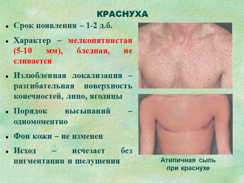 Одутловатость лица КОРЬ  1. Общеинфекционный с-м – лихорадка, «врез» температурной кривой на 2-3